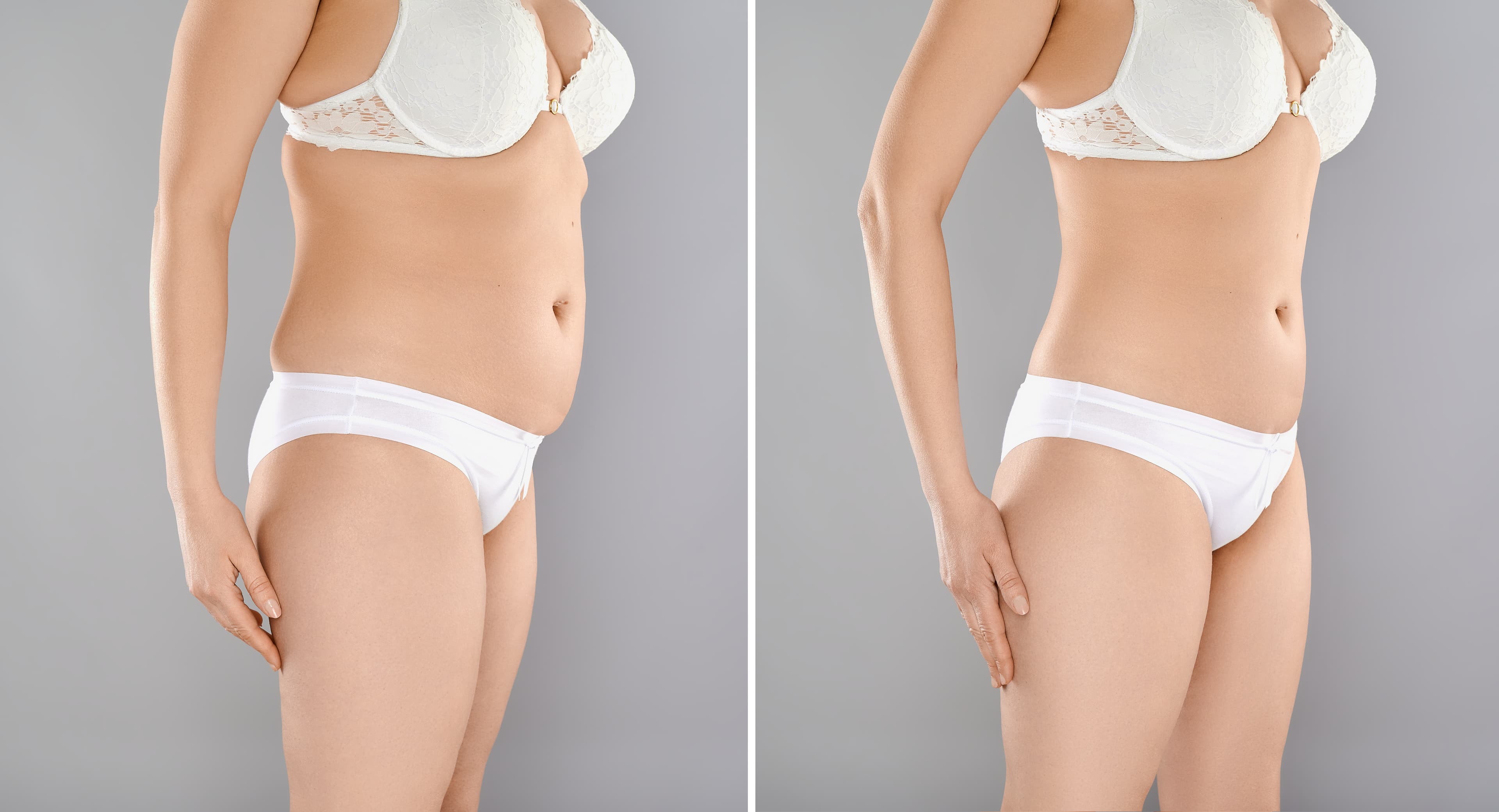 Body Contouring Before and After, Side profile