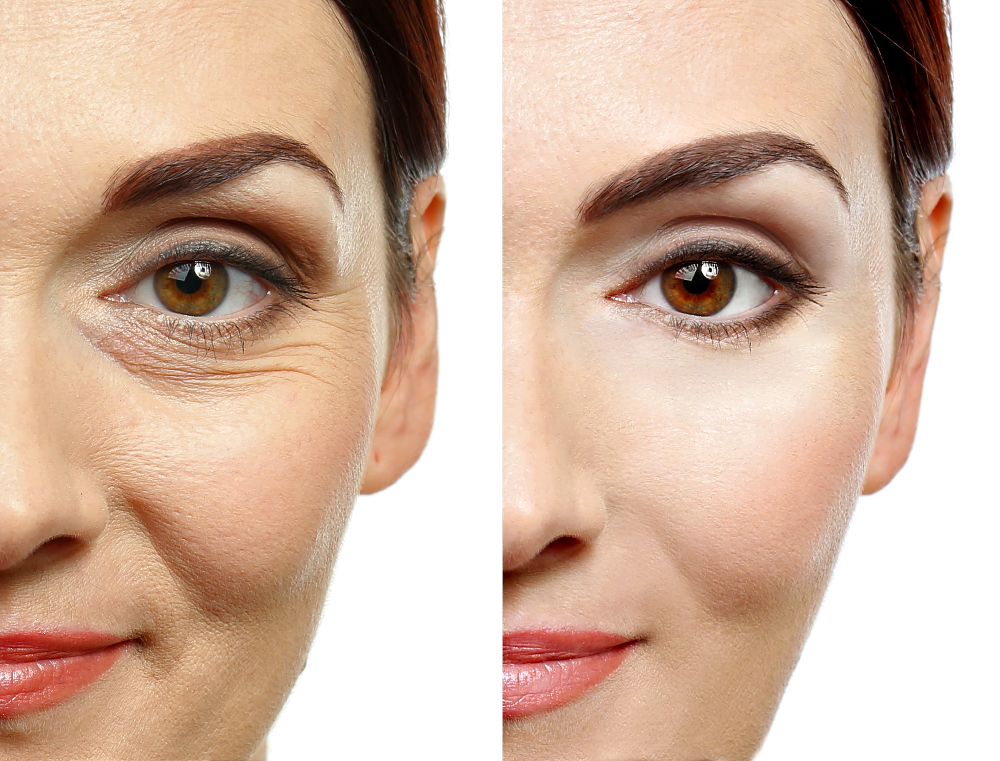 Vorher-Nachher Botox