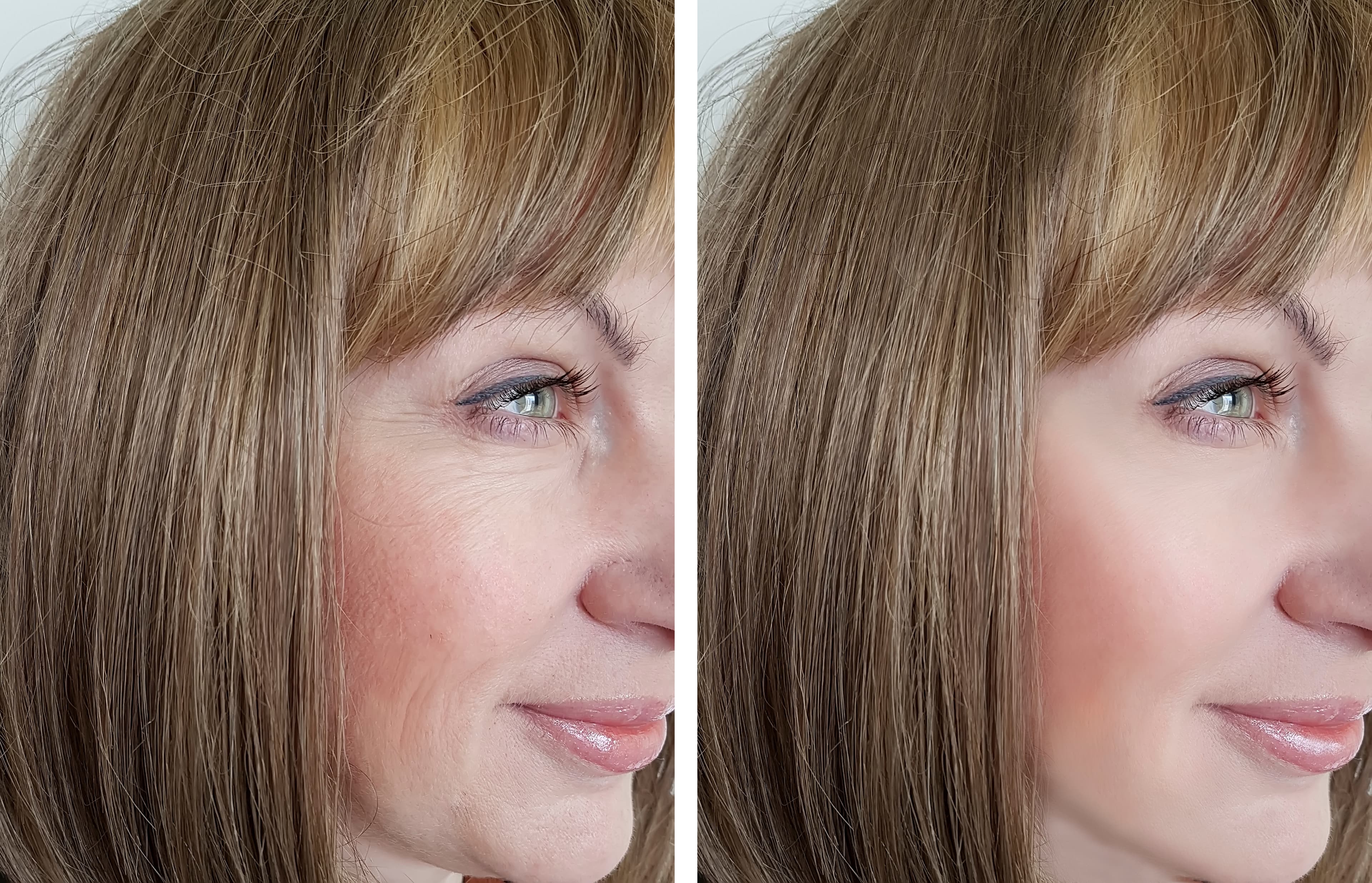 Vorher-Nachher Botox