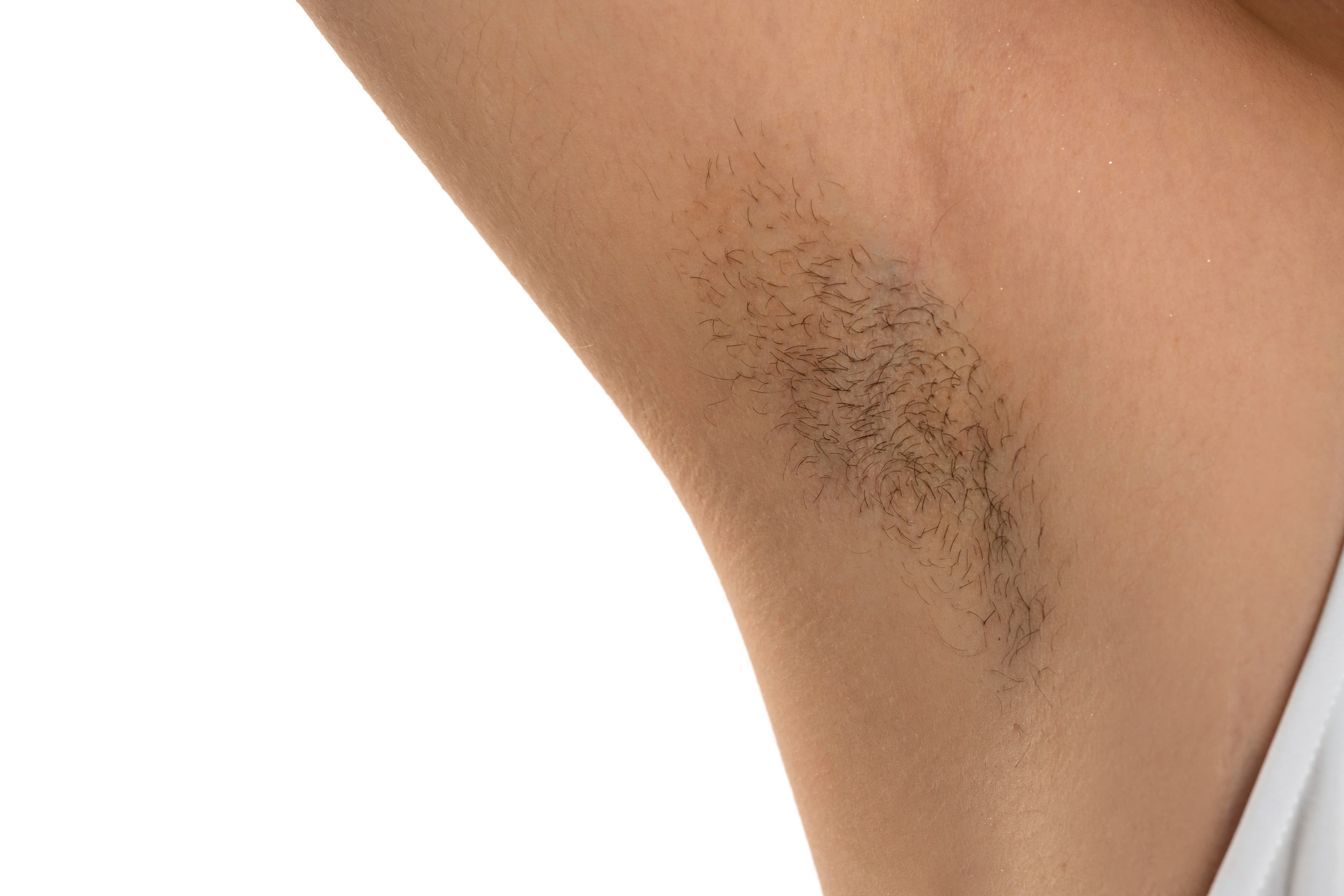 Hirsutism / Unwanted Hair Growth