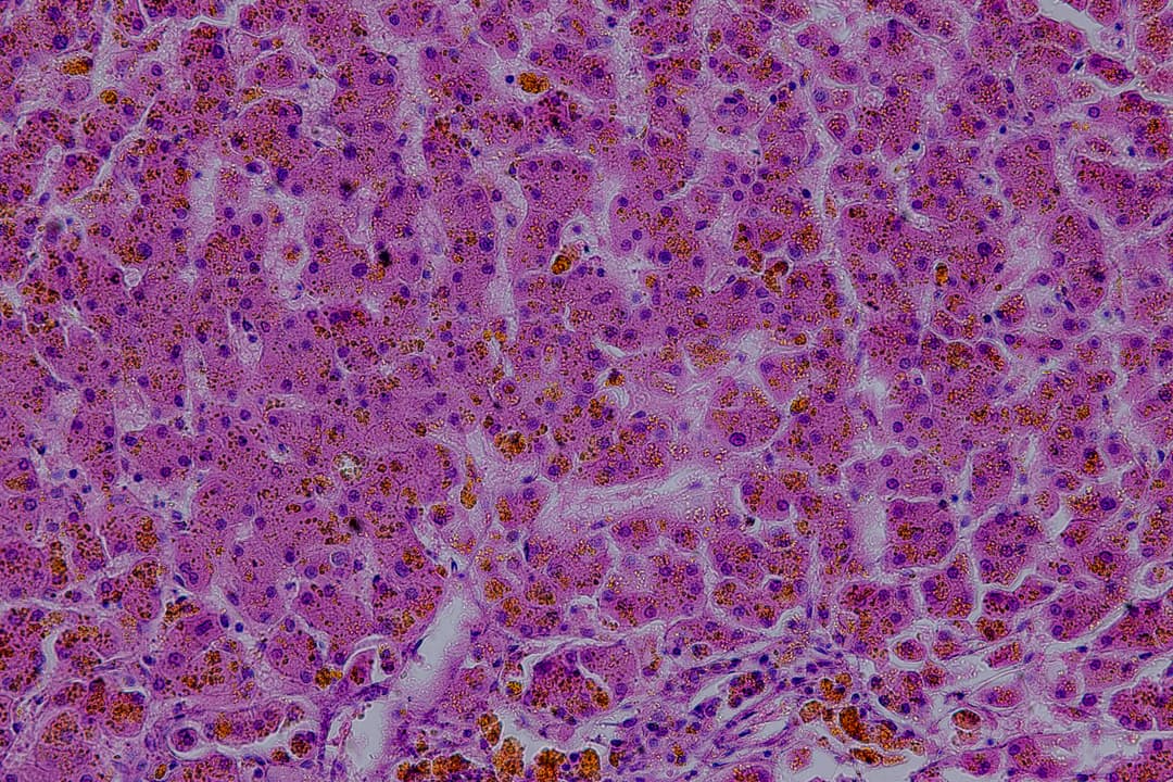 Squamous Cell Carcinoma (SCC)