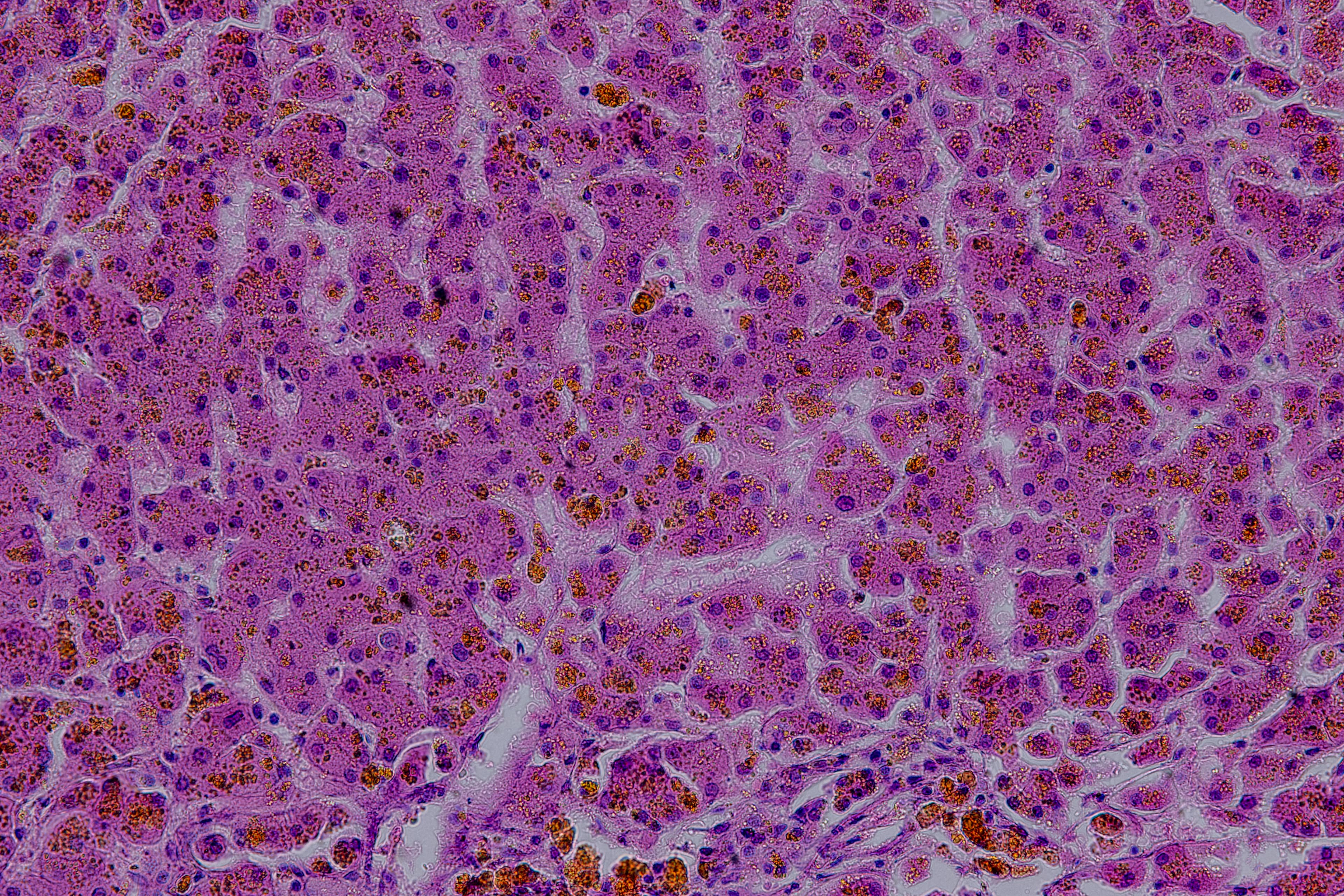 Plattenepithelkarzinom (SCC)